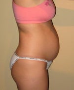 1 year after second child, 1 day before surgery