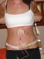 April 9th, 4th day post op