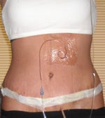 April 9th, 4th day post op
