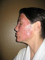Day 4- you can see the dry darker skin has flaked off; early in day