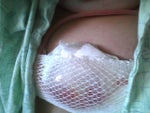 Day After Surgery (June 30, 2009)