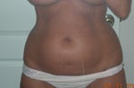 Abdomen before (love handles, too)