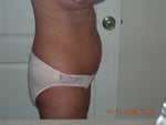 Abdomen before