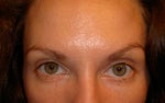 Uneven eyebrows