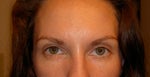 normal expression and you can see how the eyelids are uneven and the one eye is bigger than the other