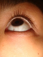Day 1 Latisse