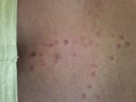 laser burns