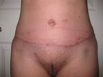 4 weeks post op