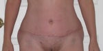 8 weeks post op