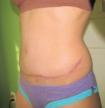 4vmonths post op_no big difference from 10 wks