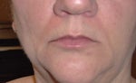 Before Juvederm Ultra