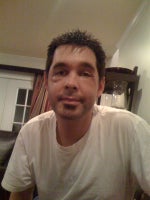 2009 before 2nd surgery for Sculptra removal