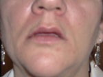After Juvederm Ultra (3 hours)