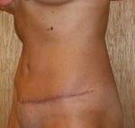 Left side view - 6 weeks