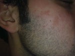 Fraxel But without the spot