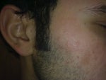 Fraxel But without the spot