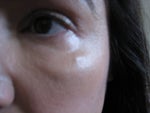 19 months after Sculptra - Before first subscision