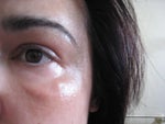 7 months after Sculptra