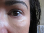 21 months after Sculptra - After second subscision