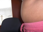Tummy tuck