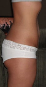 March 21st Pre-Op side view