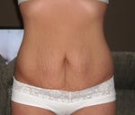 March 21st Pre-Op Front view