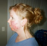 Before chin augmentation - the red spots are because of laser surgery for rosacea