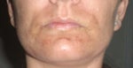 Sunday (Fraxel was on Friday)... peeling