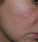 after 1 week from 1st treatment