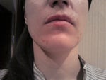 Scar that looks like line on the left above upper lip