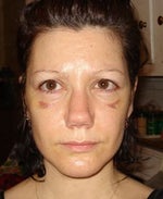 10 days after rhinoplasty. Same shape today.