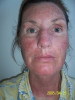 A few hours after my treatment...ready for a nap!