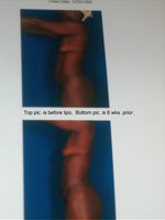 Top pic. is pre; bottom pic. is post  wks.