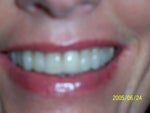 Three and a half weeks after procedure. I'm wearing lip gloss but no makeup on face or around lips. A common side effect...I can see a little bit of a gray smudge under the skin in certain light. It's visible in this photo, in fact. For me, no biggie.