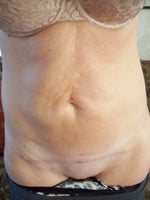 6 months post-op