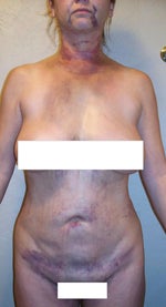 swelling and bruising after initial surgery