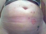 day 4 after my second treatment