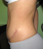 side view. 10 weeks post op
