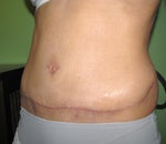 10 weeks after my tummy tuck