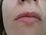 Scar that looks like line on the left above upper lip