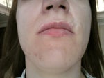 Scar that looks like line on the left above upper lip