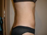 12 weeks post-op