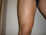 12wees post-op