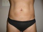 12 weeks post-op