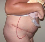 2 Days Post-op (July 1, 2009)
