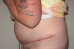 2 Days Post-op (July 1, 2009)