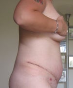 8 Days Post-op (July 7, 2009)