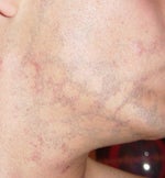 checkerboard pattern only gets worse with more treatment