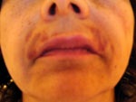 Juvederm nightmare