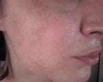 one side is not as burned as the other side of my face